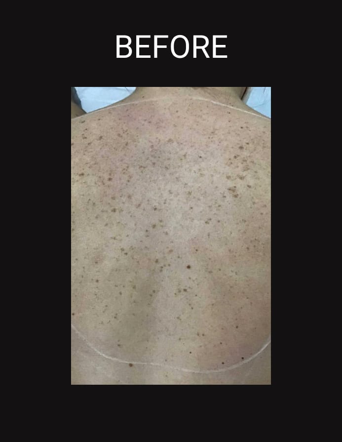 IPL Photo Facial before and after photo