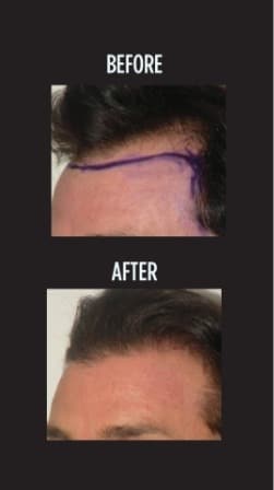 Hair Restoration before and after photo