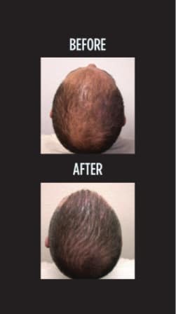 Hair Restoration before and after photo