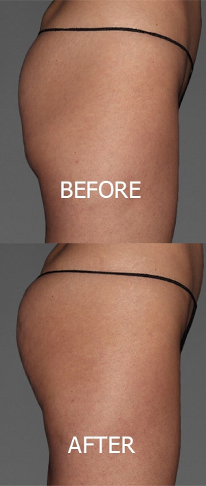Non-Surgical Brazilian Butt Lift Before and After Photo