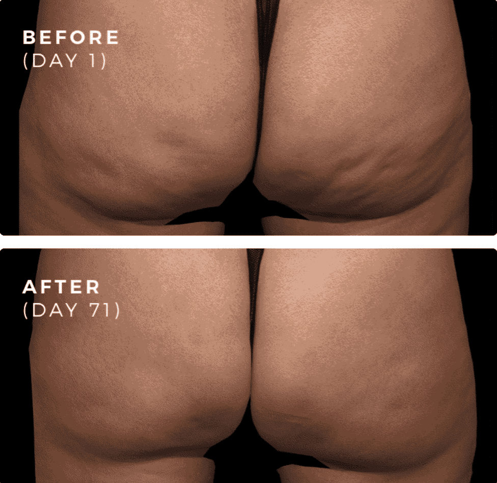 Cellulite butt treatment before and after