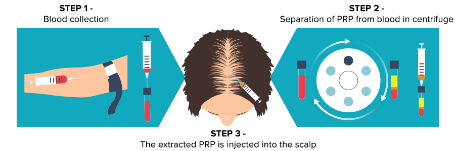 How PRP Hair Restoration works illustration