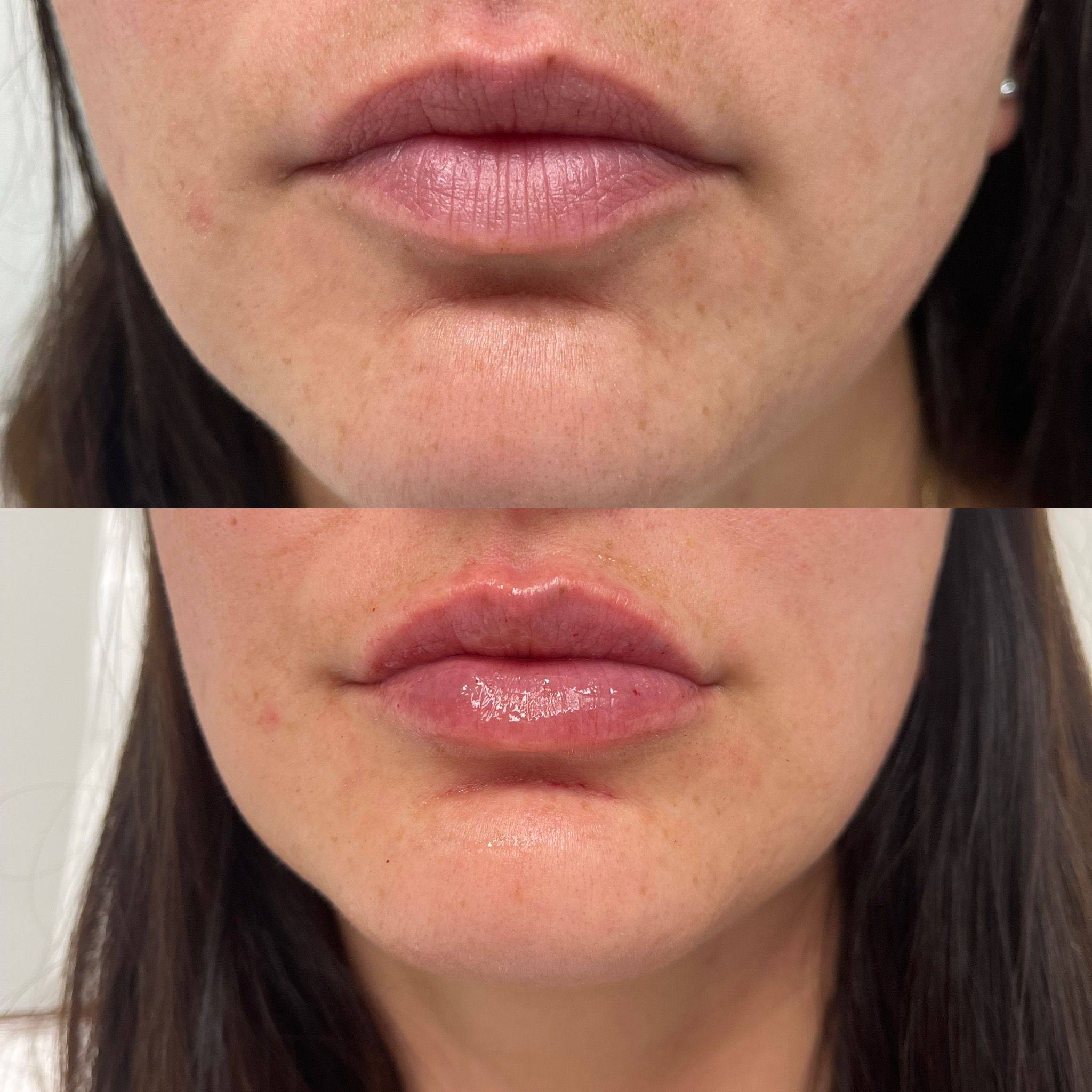 Fillers before and after photo