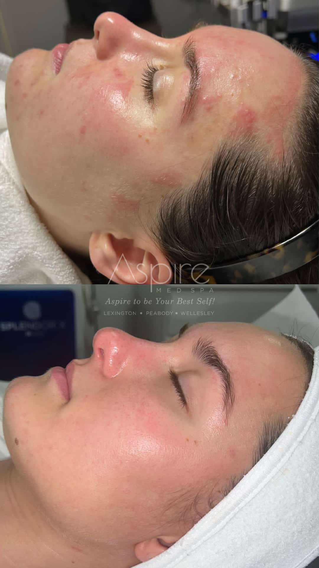 IPL Photo Facial before and after photo