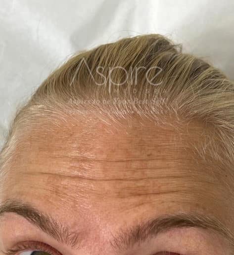 Botox / Xeomin before and after photo