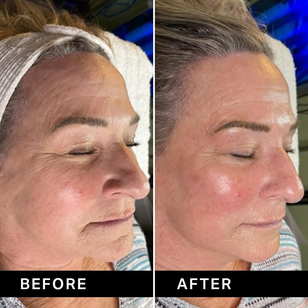 Hydrafacial MD before and after photo
